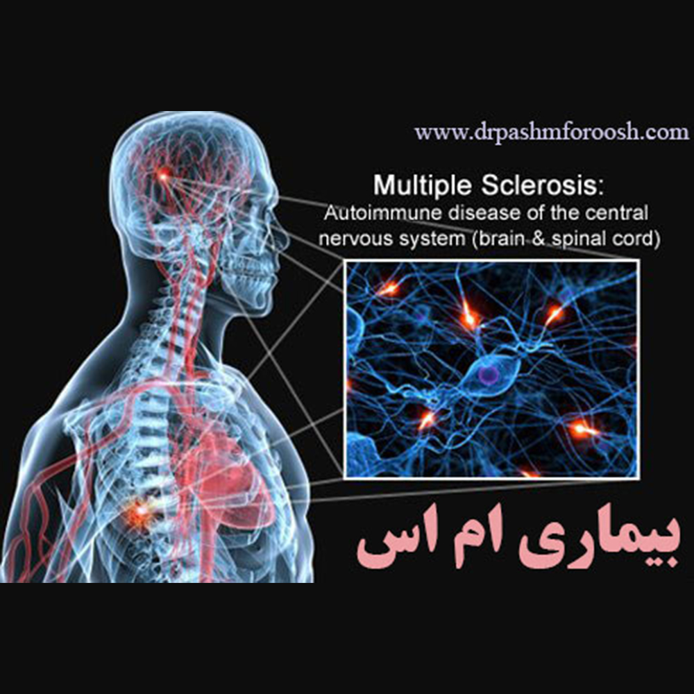 بیماری ام‌اس (MS) | علائم، دلایل، روش‌های تشخیص و درمان
